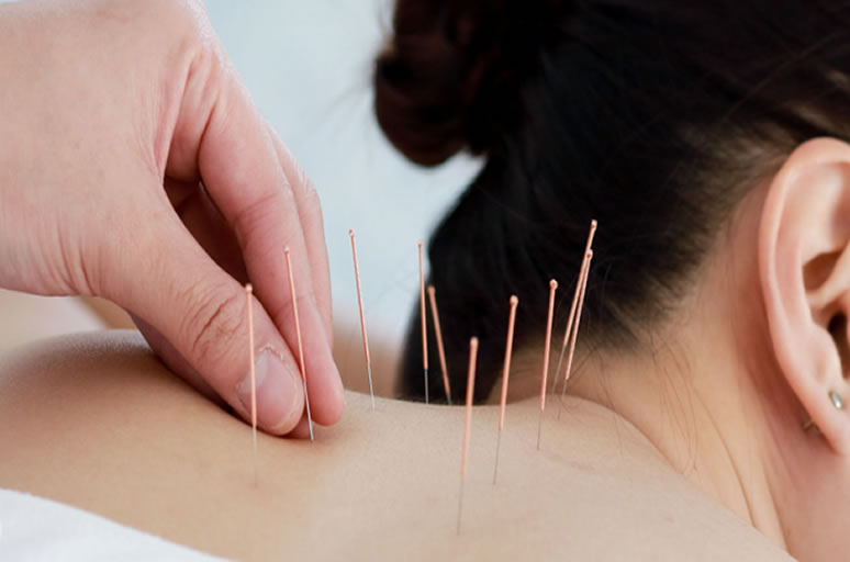 Acupuntura